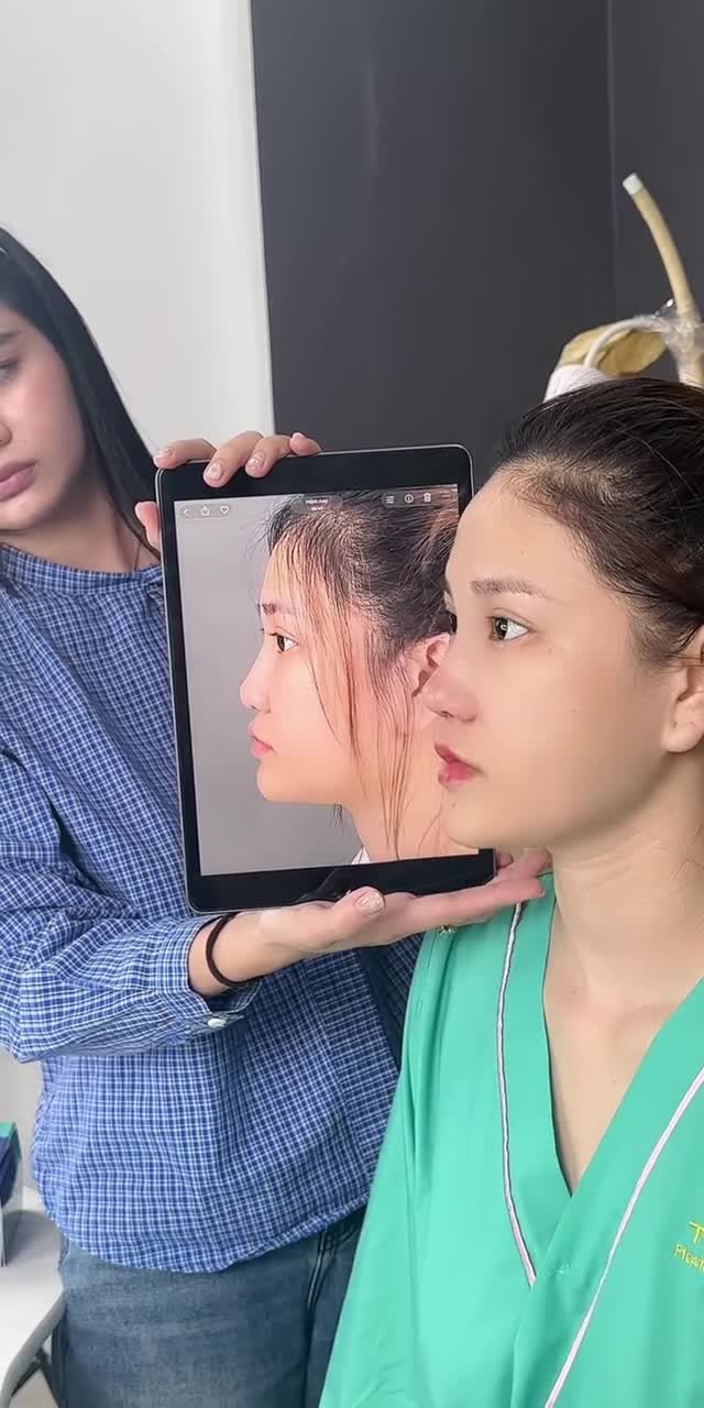 HOÀN THÀNH CA NÂNG MŨI CẤU TRÚC SỬA LẠI