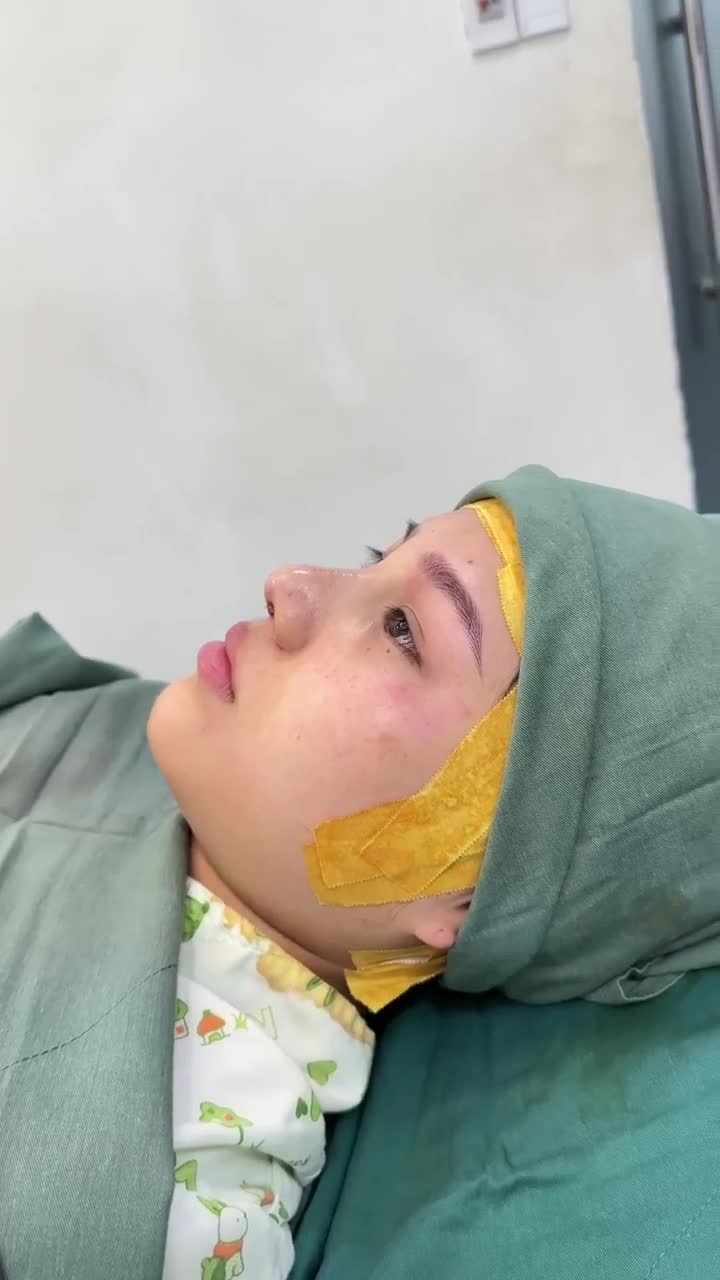 TRẢ KẾT QUẢ NÂNG MŨI NGAY SAU PHẪU THUẬT KH. THÙY LINH (SINGAPORE)