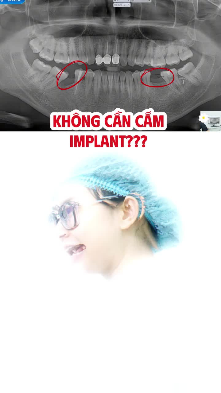 "TIẾT KIỆM" 2 CÂY IMPLANT NHỜ CHỈNH NHA - RĂNG KHÔN ĐƯỢC TẬN DỤNG ĐỂ THAY THẾ RĂNG 6