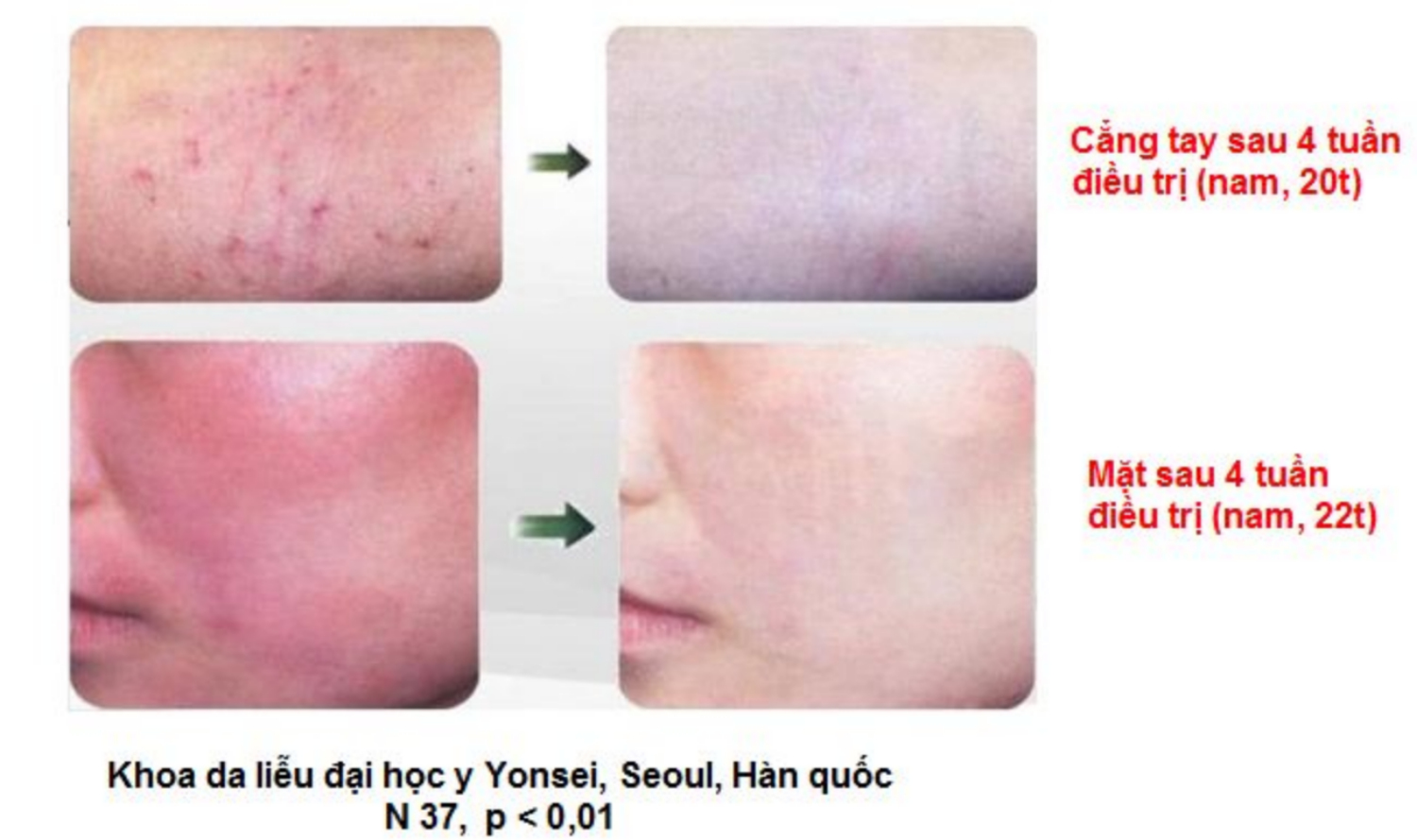 atopalm viem da co dia nguoi lon