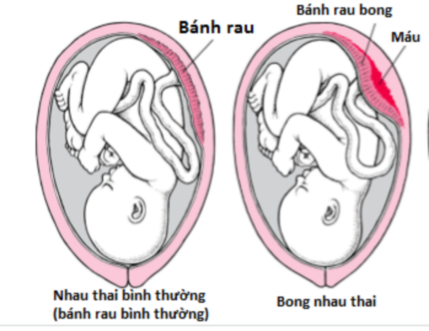 Bong nhau thai (rau bong non)