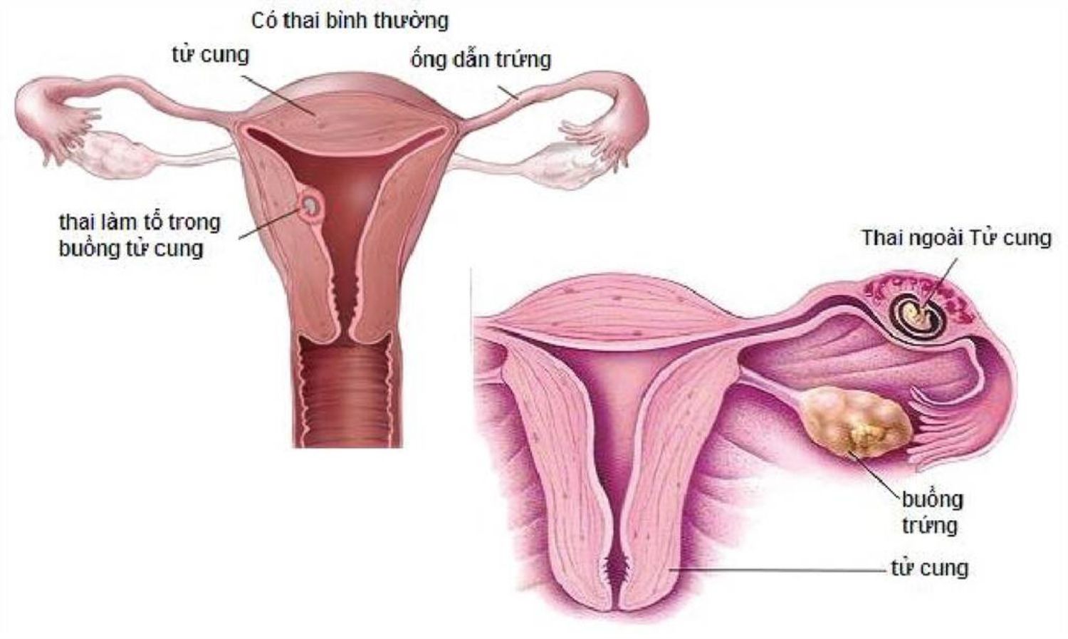 Thai ngoài tử cung (chửa ngoài dạ con)