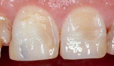 Mòn men răng và các biện pháp phục hồi