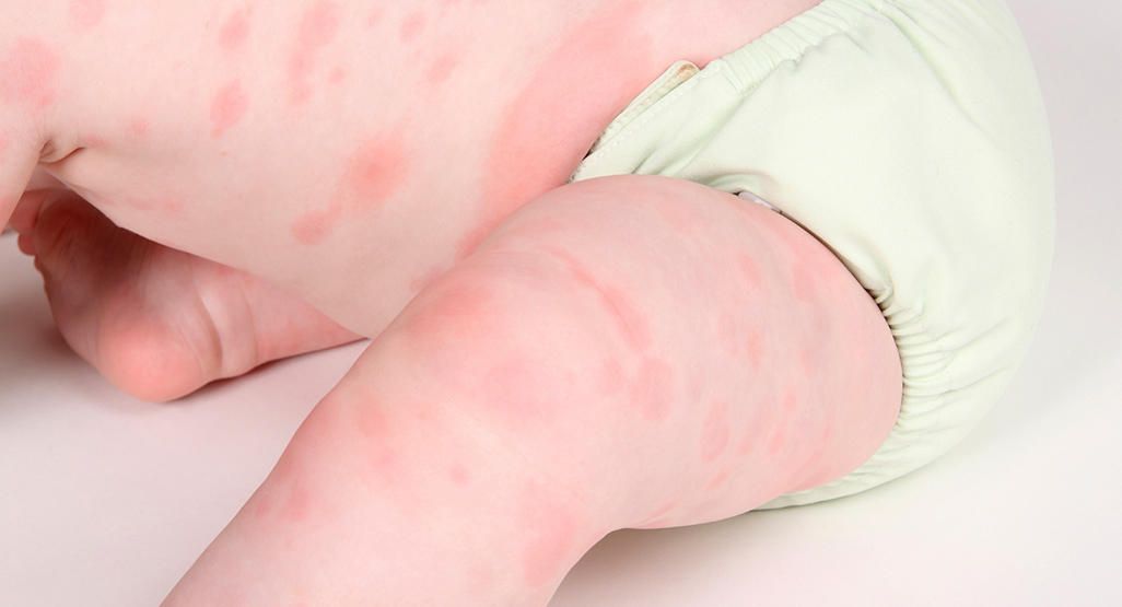 Bạn có thể thực sự bảo vệ con mình khỏi dị ứng?