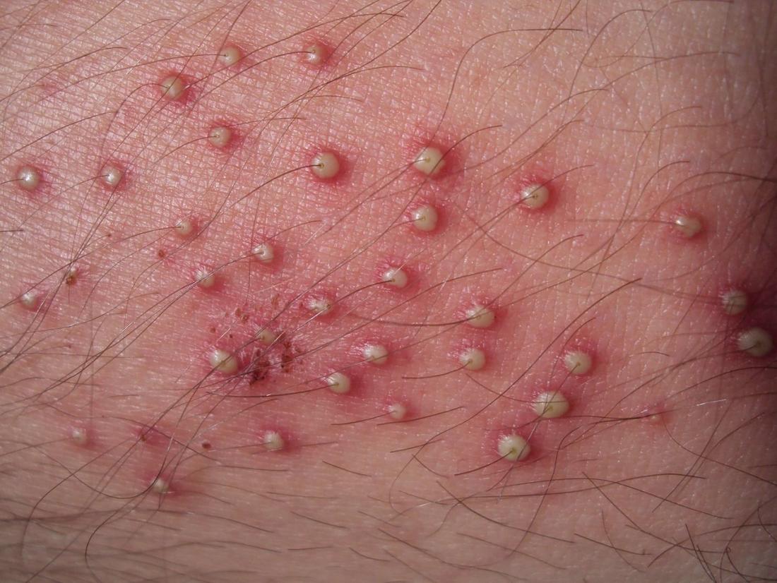 Viêm nang lông và cách điều trị