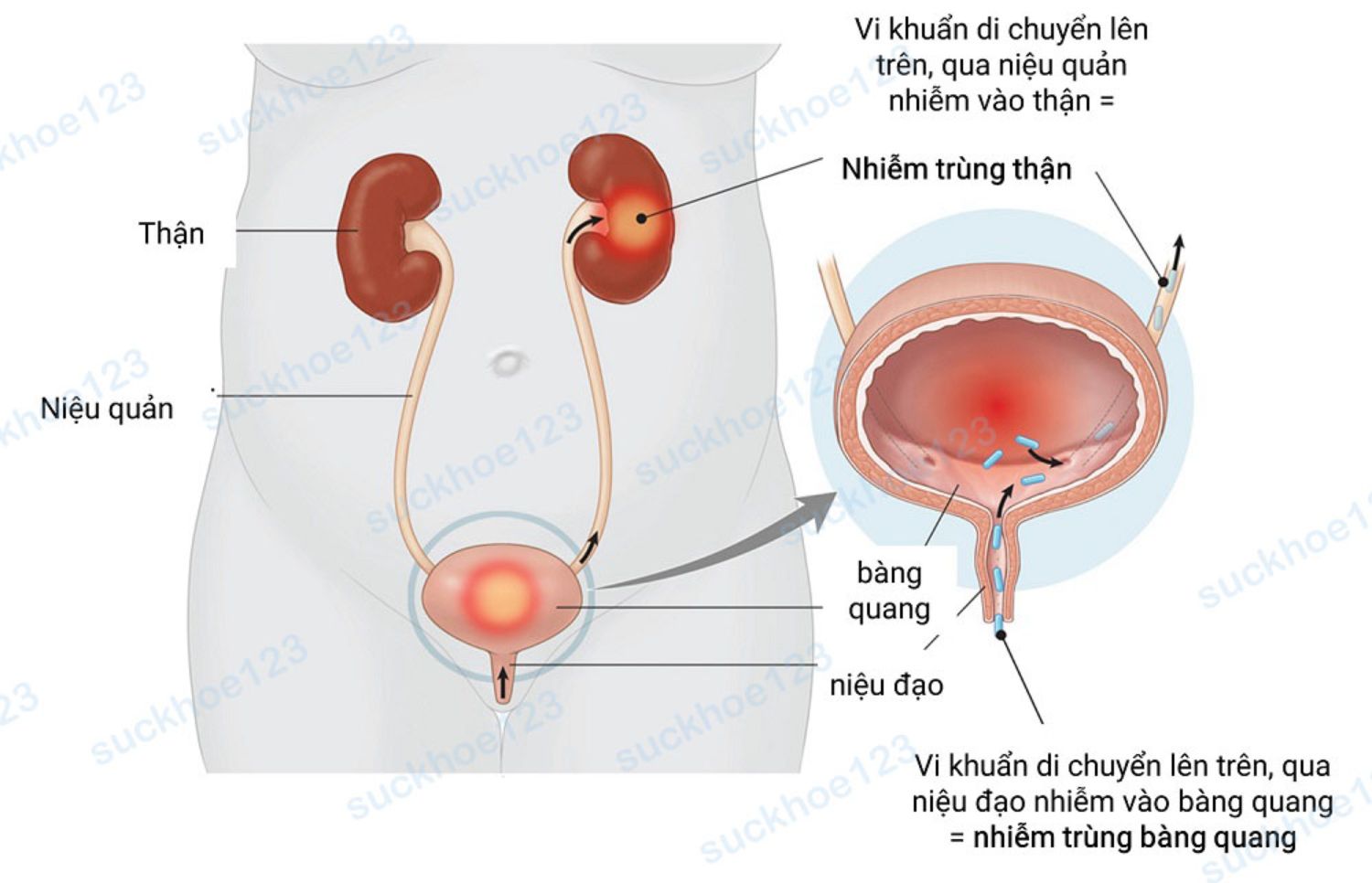 viem duong tiet nieu1