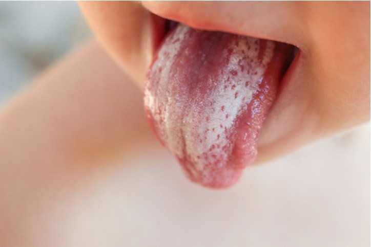 Viêm nướu răng cấp tính ở trẻ: Những điều cần biết