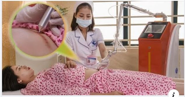 Chiếu tia plasma sau sinh - Phục hồi vết rạch/mổ, lấy lại tự tin cho mẹ bầu