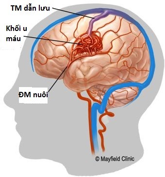 “Chuẩn vàng” để chẩn đoán u máu trong não - Bệnh viện Việt Đức