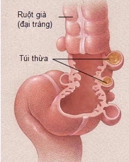 Bệnh lý túi thừa đại tràng – Phát hiện sớm để phòng những biến chứng nguy hiểm - Bệnh viện Việt Đức