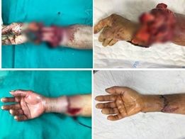 Trồng nối thành công cẳng tay bị đứt rời do máy tuốt lúa - Bệnh viện 108