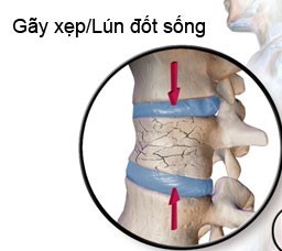Xẹp thân đốt sống do loãng xương - Bệnh viện 108