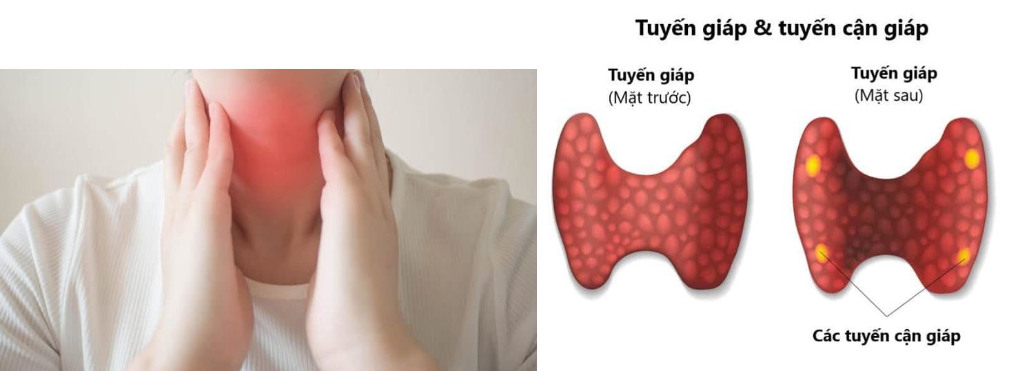 U tuyến cận giáp - Bệnh viện 108