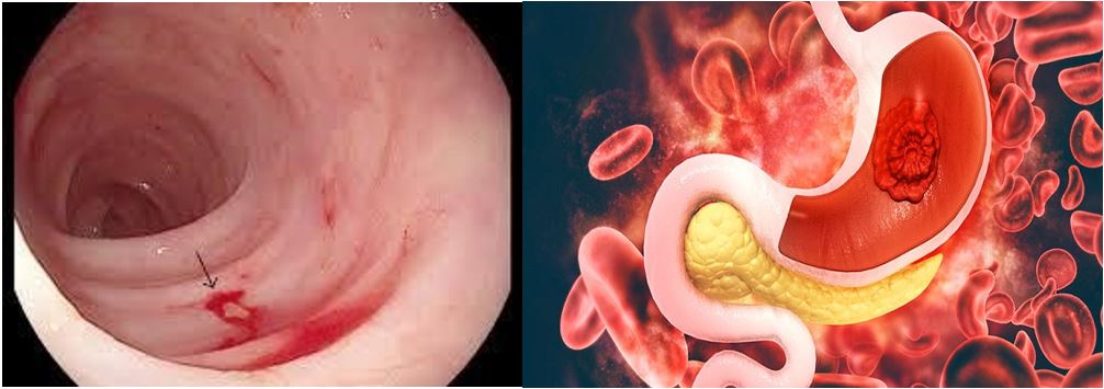 Những điều cần biết về xuất huyết tiêu hóa - Bệnh viện 108