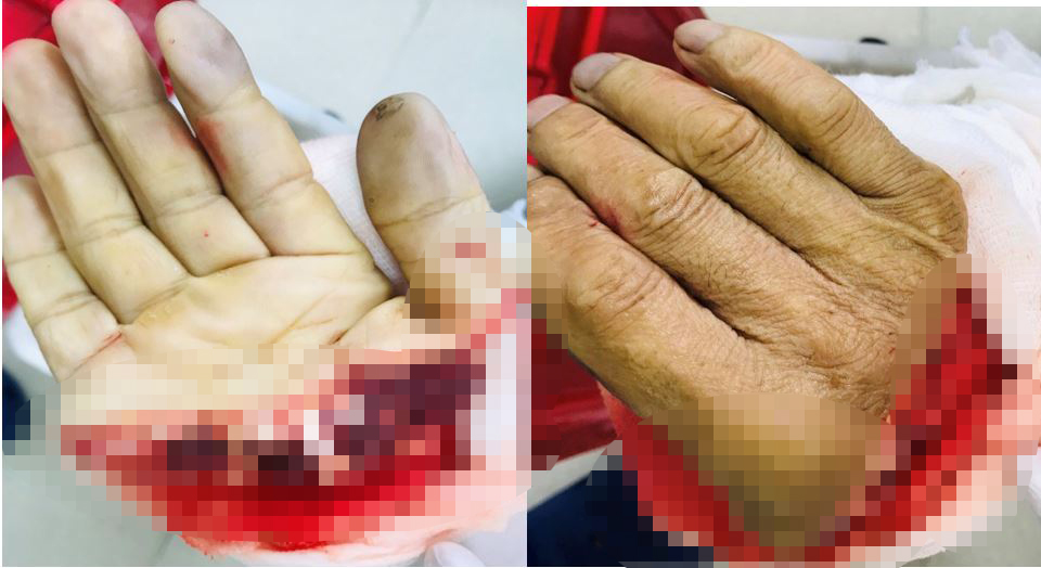 Bảo quản chi thể đứt rời đúng cách - yếu tố quan trọng trong thành công nối chi thể - Bệnh viện 108