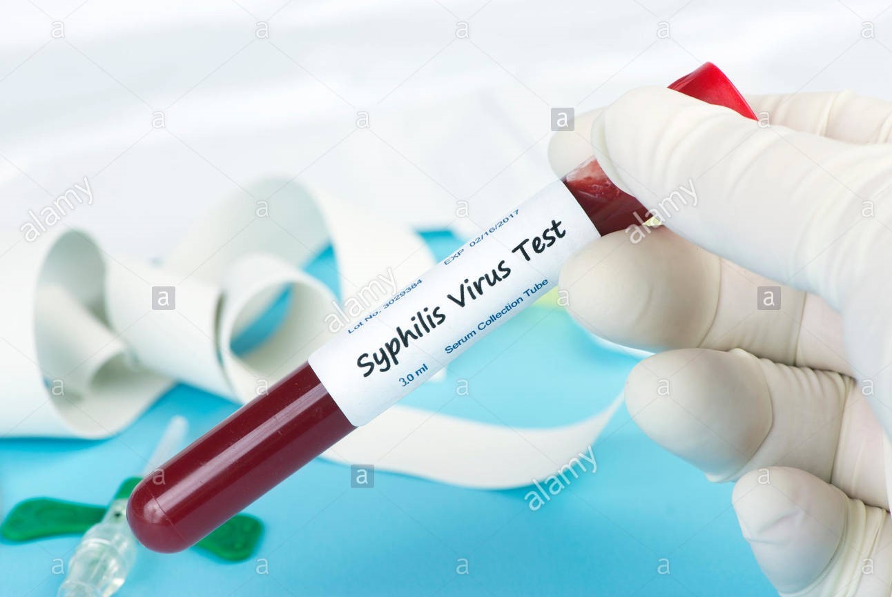 Xét nghiệm sàng lọc bệnh Giang mai (Syphilis tpa) trên hệ thống xét nghiệm tự động miễn dịch hóa phát quang tăng cường VITROS 3600 - Bệnh viện 108