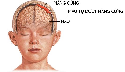 Máu tụ dưới màng cứng mạn tính ở người cao tuổi - Bệnh viện 108