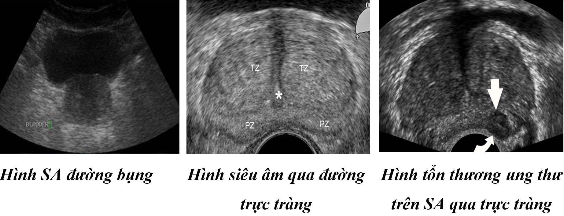 Chẩn đoán sớm ung thư tuyến tiền liệt bằng siêu âm và sinh thiết tuyến tiền liệt qua đầu dò trực tràng hai bình diện - Bệnh viện 108