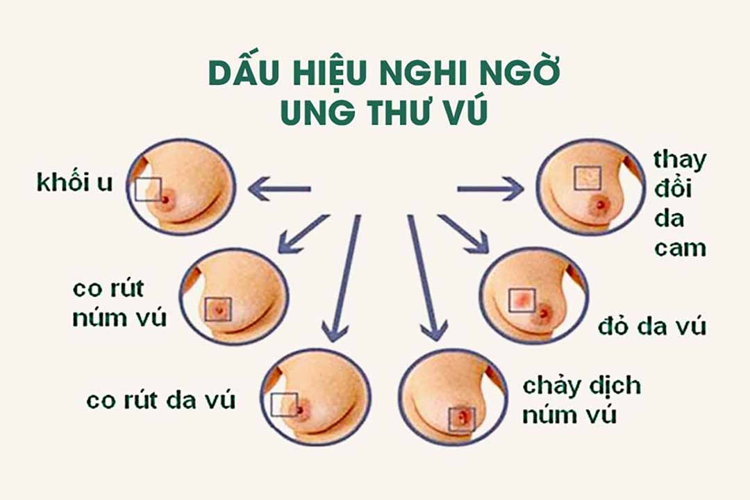 Ung thư vú: phát hiện sớm bệnh có thể điều trị khỏi! - Bệnh viện 108