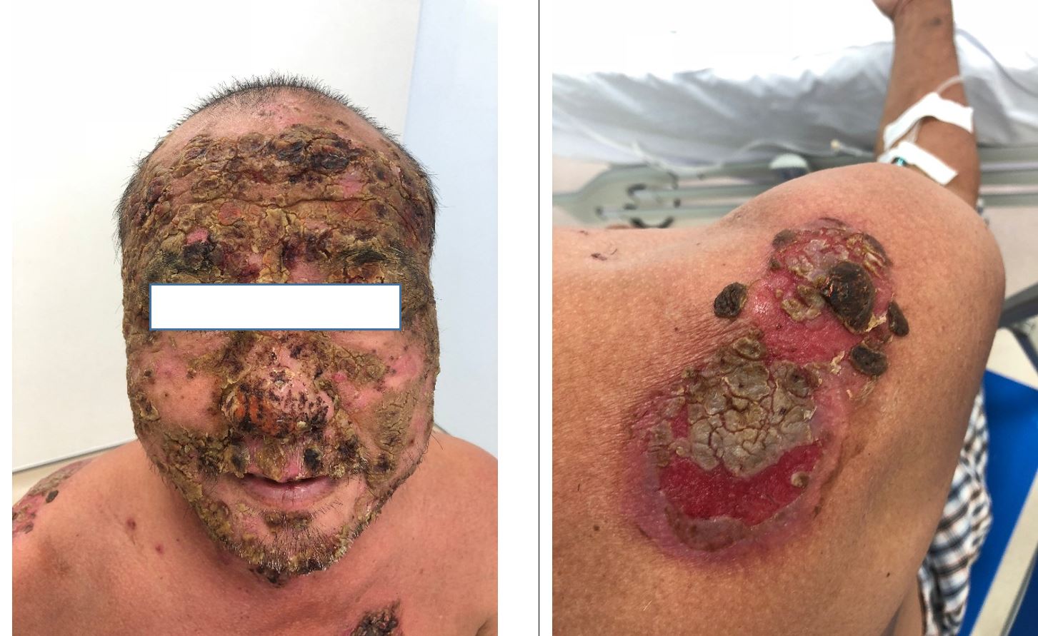 Phương pháp chăm sóc hiệu quả đối với người bệnh mắc Pemphigus Vulgaris - Bệnh viện 108