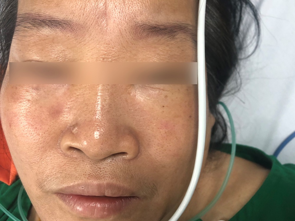 Côn trùng cắn: Vết thương nhỏ nhưng ẩn chứa nguy hiểm khó lường - Bệnh viện 108