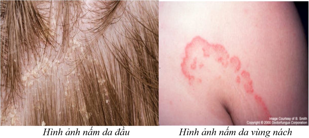 Cẩn thận bệnh nấm da khi trời nồm - Bệnh viện 108