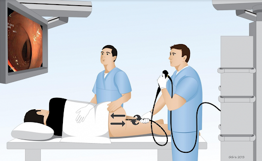 Nội soi đại tràng phát hiện sớm bệnh lý túi thừa đại tràng - Bệnh viện Việt Đức