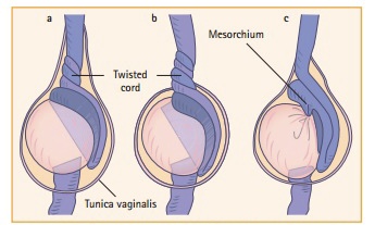 Nguyên nhân Xoắn tinh hoàn - Bệnh viện Việt Đức