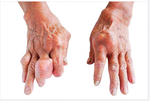 CẢNH BÁO 5 BIẾN CHỨNG NGUY HIỂM CỦA BỆNH GOUT