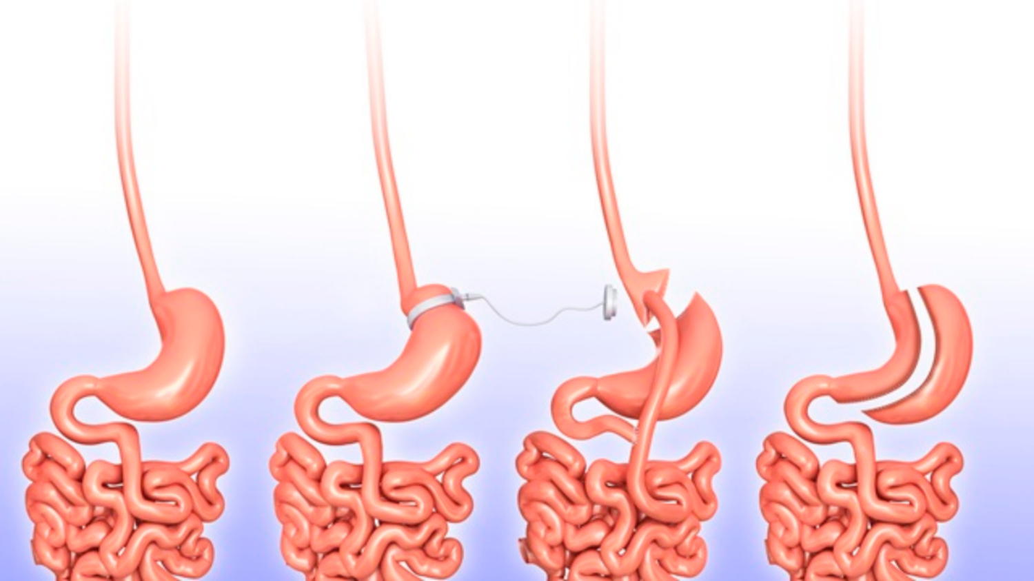 Những điều cần biết về phẫu thuật cắt vạt dạ dày để giảm cân