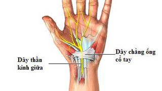 Sử dụng siêu âm để phát hiện tổn thương trong hội chứng ống cổ tay - Bệnh viện 108