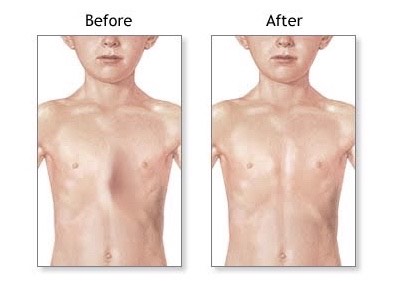 Cách phát hiện và điều trị bệnh lý dị dạng lồng ngực bẩm sinh - Bệnh viện Việt Đức