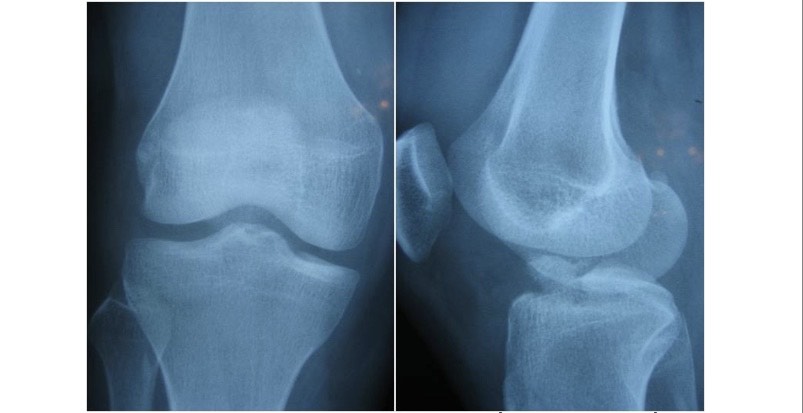 Cách nhận biết bệnh đứt dây chằng chéo trước khớp gối - Bệnh viện Việt Đức