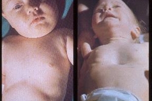 Một số dấu hiệu cha mẹ cần biết để đưa trẻ đi khám sớm