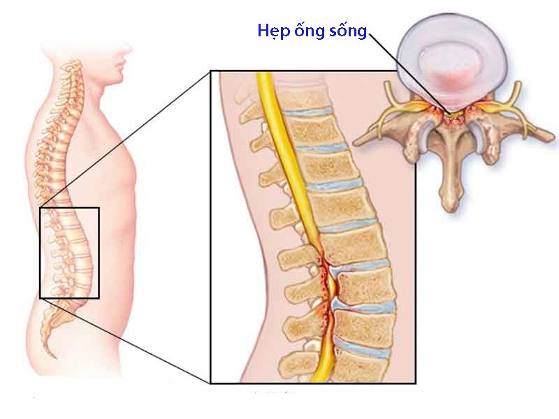 Bệnh lý Hẹp ống sống - Bệnh viện Việt Đức