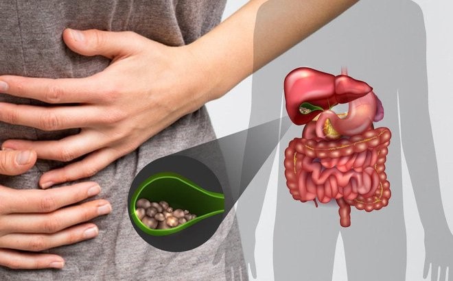 Sỏi túi mật gây ra nhiều biến chứng nguy hiểm nếu không phát hiện kịp thời -  Bệnh viện Việt Đức
