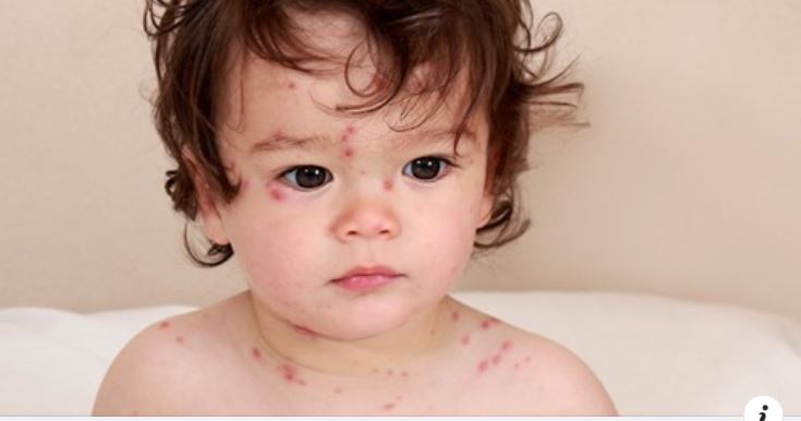 THỦY ĐẬU VÀO MÙA, LÀM SAO ĐỂ PHÒNG TRÁNH BỆNH Ở TRẺ?