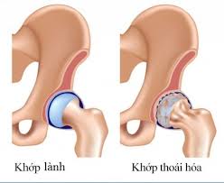 Thoái hóa khớp háng - Bệnh Viện Việt Đức