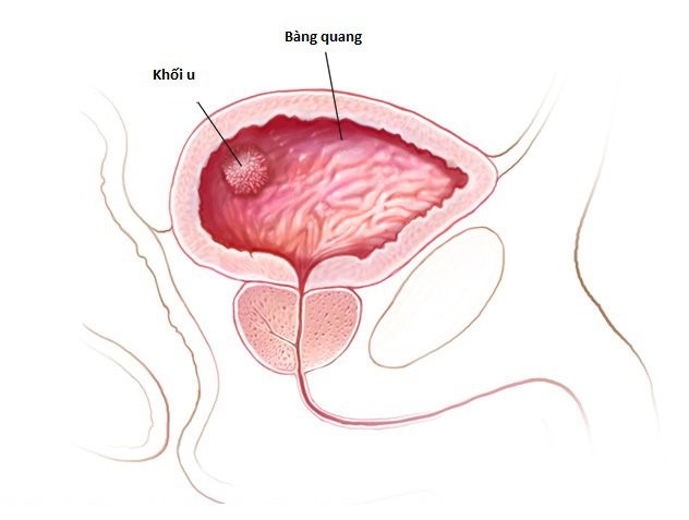 Ung thư bàng quang - Bệnh viện Việt Đức