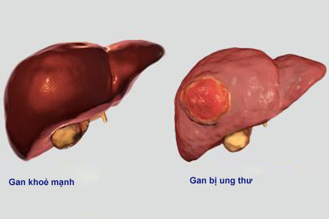 Ung thư “sát thủ” với nam giới bắt nguồn từ bệnh lý mãn tính - Bệnh viện Việt Đức