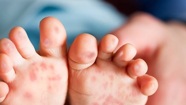Bệnh tay chân miệng vào mùa - Bệnh viện 108