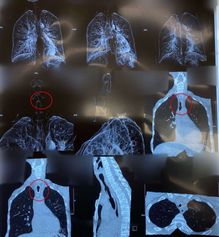 Xử trí cho bệnh nhân tái hẹp khí quản sau nong và đặt stent - Bệnh viện 108