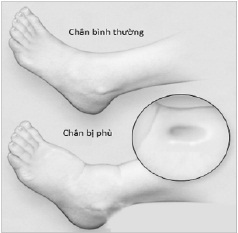 5 dấu hiệu cảnh báo sớm suy tim - bệnh viện 108