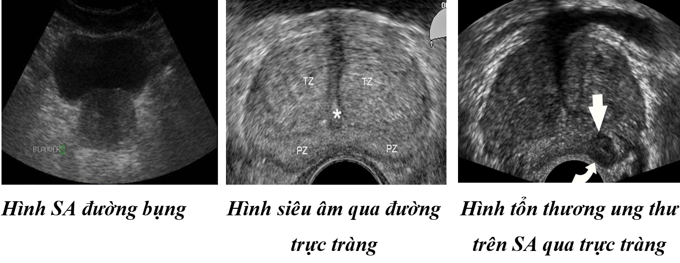 Chẩn đoán sớm ung thư tuyến tiền liệt bằng siêu âm và sinh thiết tuyến tiền liệt qua đầu dò trực tràng hai bình diện - Bệnh viện 108