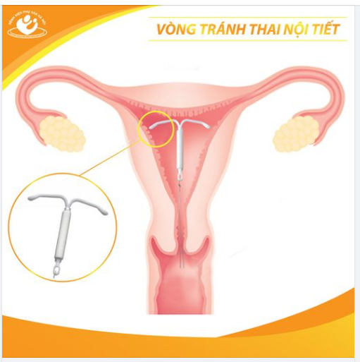 Vòng tránh thai nội tiết  Khác biệt gì so với vòng tránh thai chứa đồng?