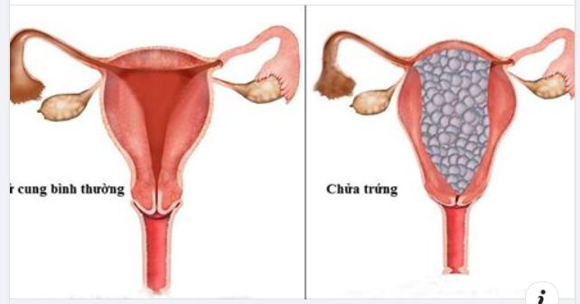 BỆNH NHÂN 50 TUỔI PHẢI CẮT TOÀN BỘ TỬ CUNG KHI CÓ THAI NGHÉN BẤT THƯỜNG