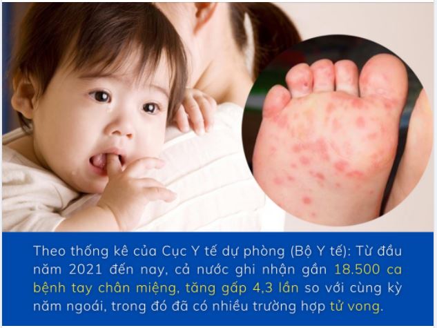 BỆNH TAY CHÂN MIỆNG GIA TĂNG RẤT NHANH - BIẾN CHỨNG NGUY HIỂM