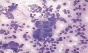 Những điều cần biết về hội chứng thực bào máu ở trẻ