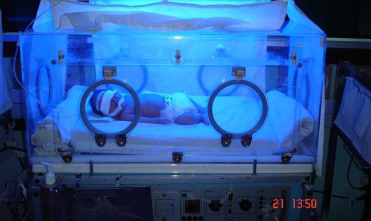 Một vài tác dụng phụ của chiếu đèn vàng da sơ sinh