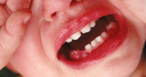 Viêm nướu răng cấp tính ở trẻ: Những điều cần biết